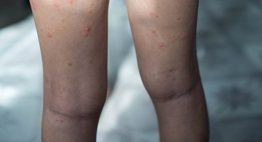 Симптомы повторной ветрянки у ребенка