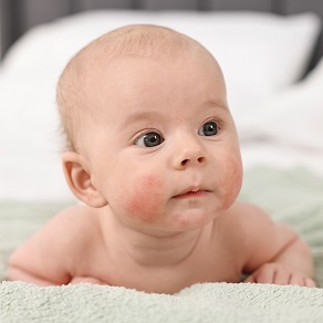 Сыпь на щеках у ребенка