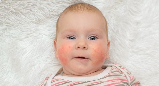 Аллергическая сыпь на щеках ребенка