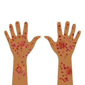 Менингококковая инфекция