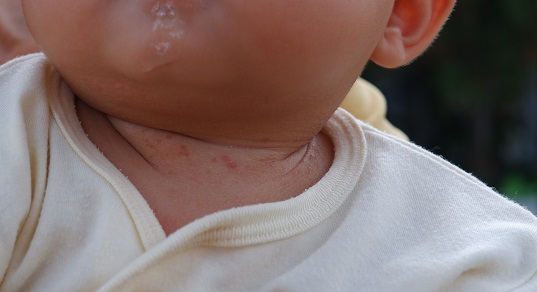Мелкая сыпь у месячного ребенка