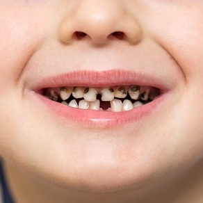 Бутылочный кариес у детей 