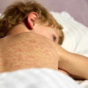 Крапивница у детей