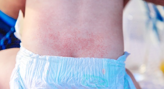 Аллергическая сыпь на ягодицах