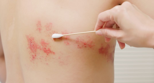 Чем повторная ветрянка отличается от опоясывающего лишая