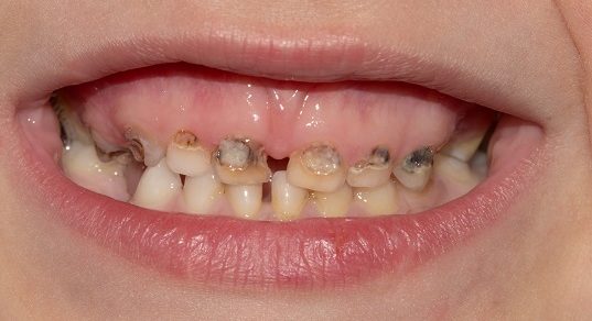 Как выглядит бутылочный кариес – первые симптомы