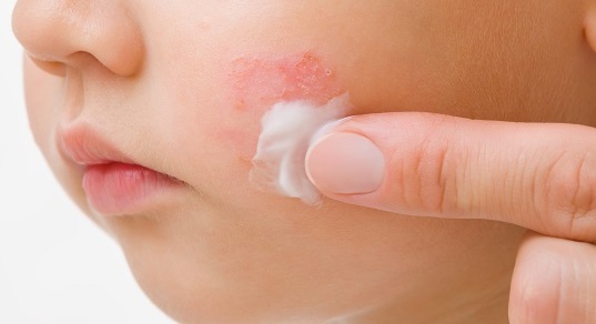 Что делать, если у ребенка сыпь на щеках