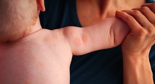 Диагностика атопического дерматита у детей до года