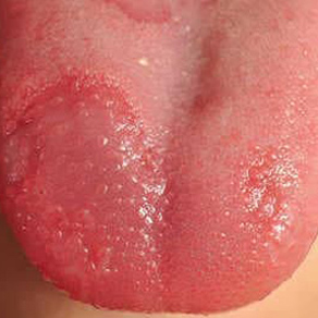 Глоссит на языке у детей - причины, виды и методы лечения глоссита у  ребенка в «СМ-Клиника» для детей и подростков