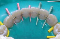 Шинирование зубов у детей