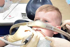 Лечение зубов под седацией закисью азота у детей